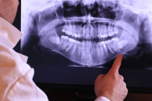 Best Emergency Wisdom Teeth Removal in Chigan Center, MI
